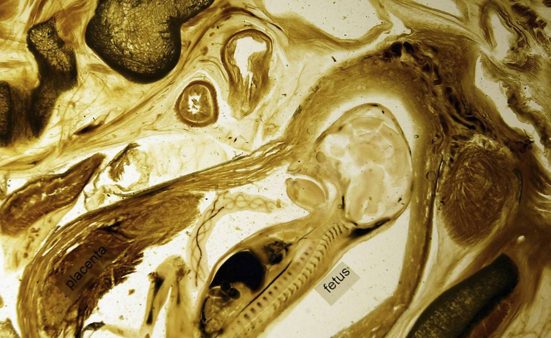 История медицинского каннибализма